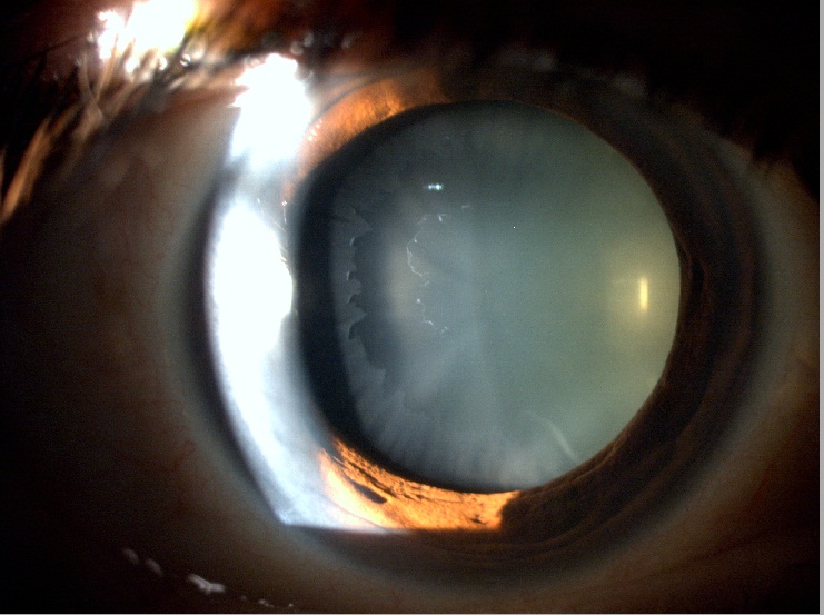Glaucoma secundario