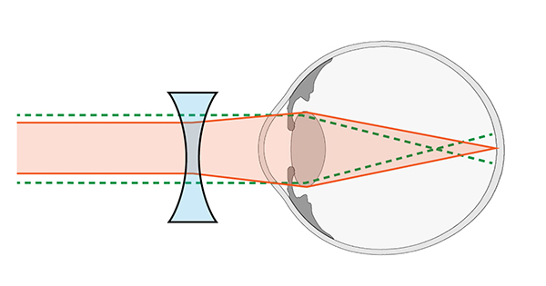 Divergent lens for myopia. Diagram