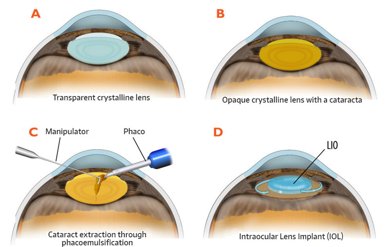 More about cataracts
