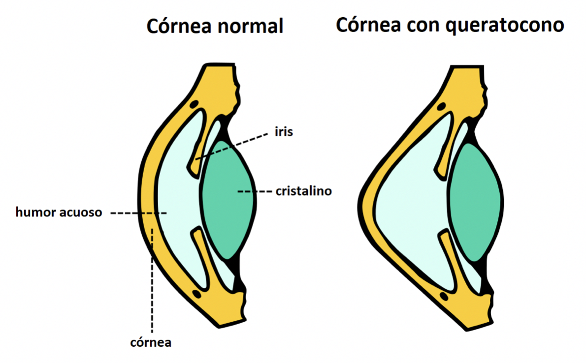Diferencias en el perfil de la córnea